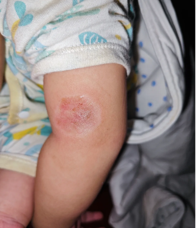 大钱疮,也被称为钱币状湿疹或体癣,其引发原因复杂多样