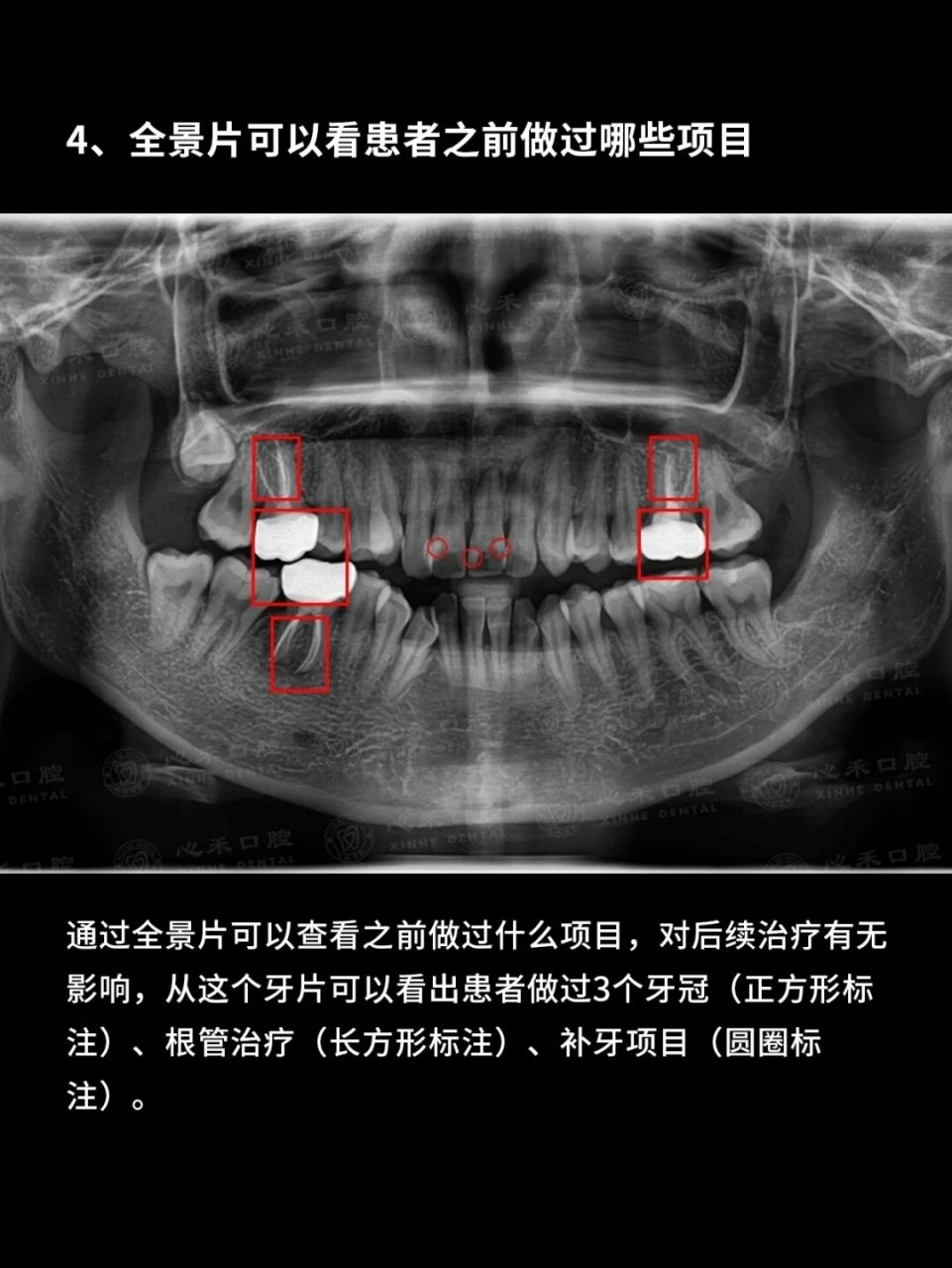 为什么一定要拍口腔全景片?