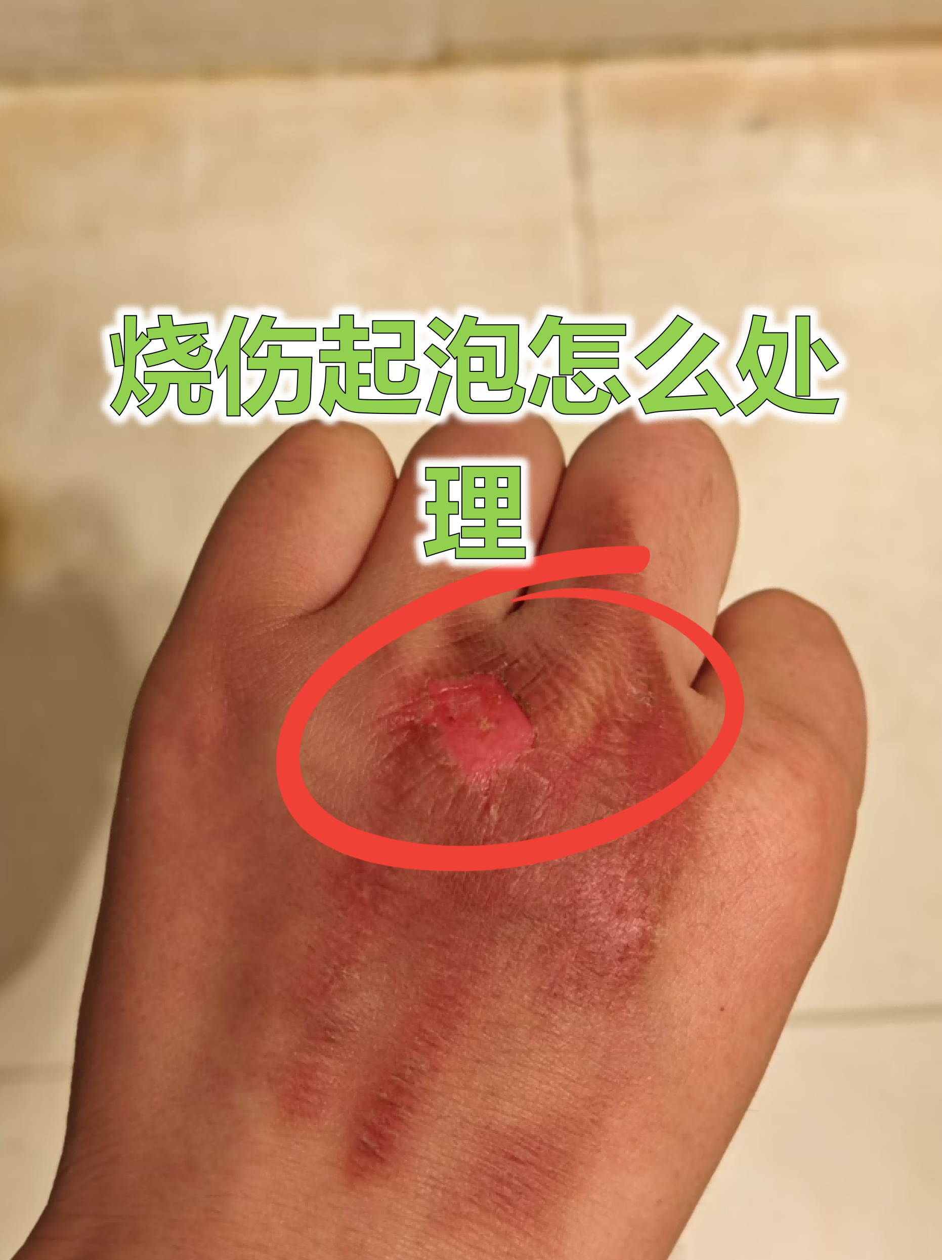 烧伤起泡是皮肤受到高温损伤后的常见反应,正确