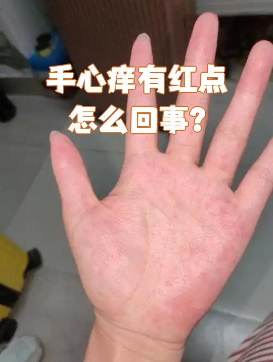 为什么手掌有红点