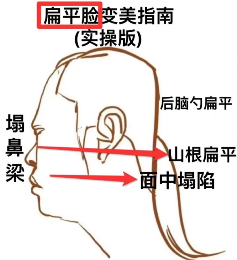 鼻山根塌陷怎么补救图片