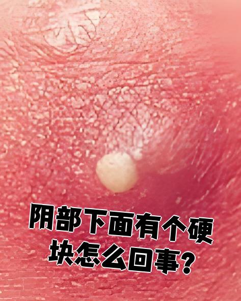 阴部下面出现硬块,常见原因包括毛囊炎和前庭大腺囊肿