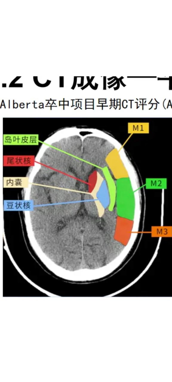 脑基底节区解剖图图片