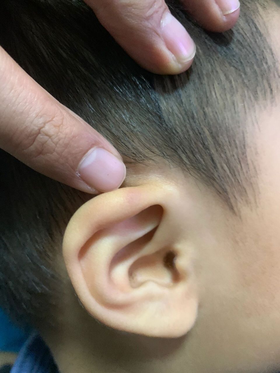 宝宝眼睛红了,长针眼(麦粒肿)怎么办?