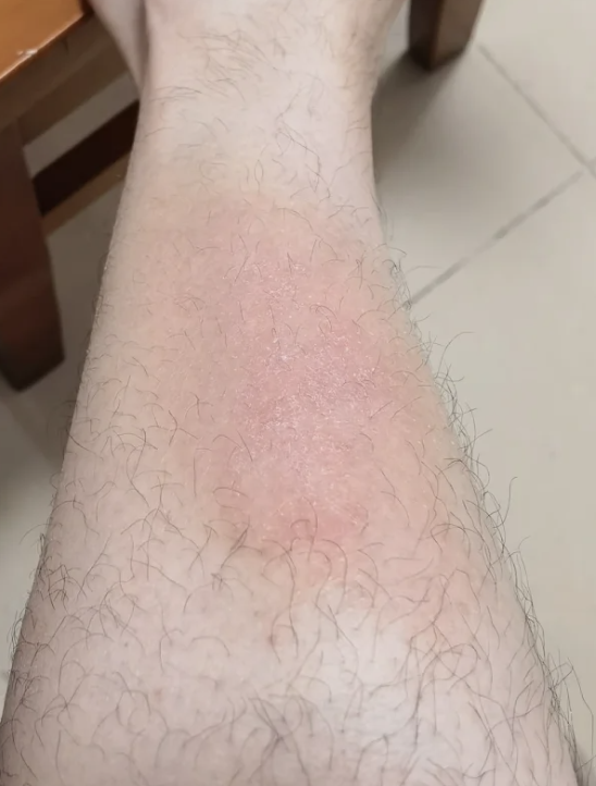 冬天小腿痒,越挠越痒,常见原因有皮肤干燥,过敏或湿疹,用药要根据