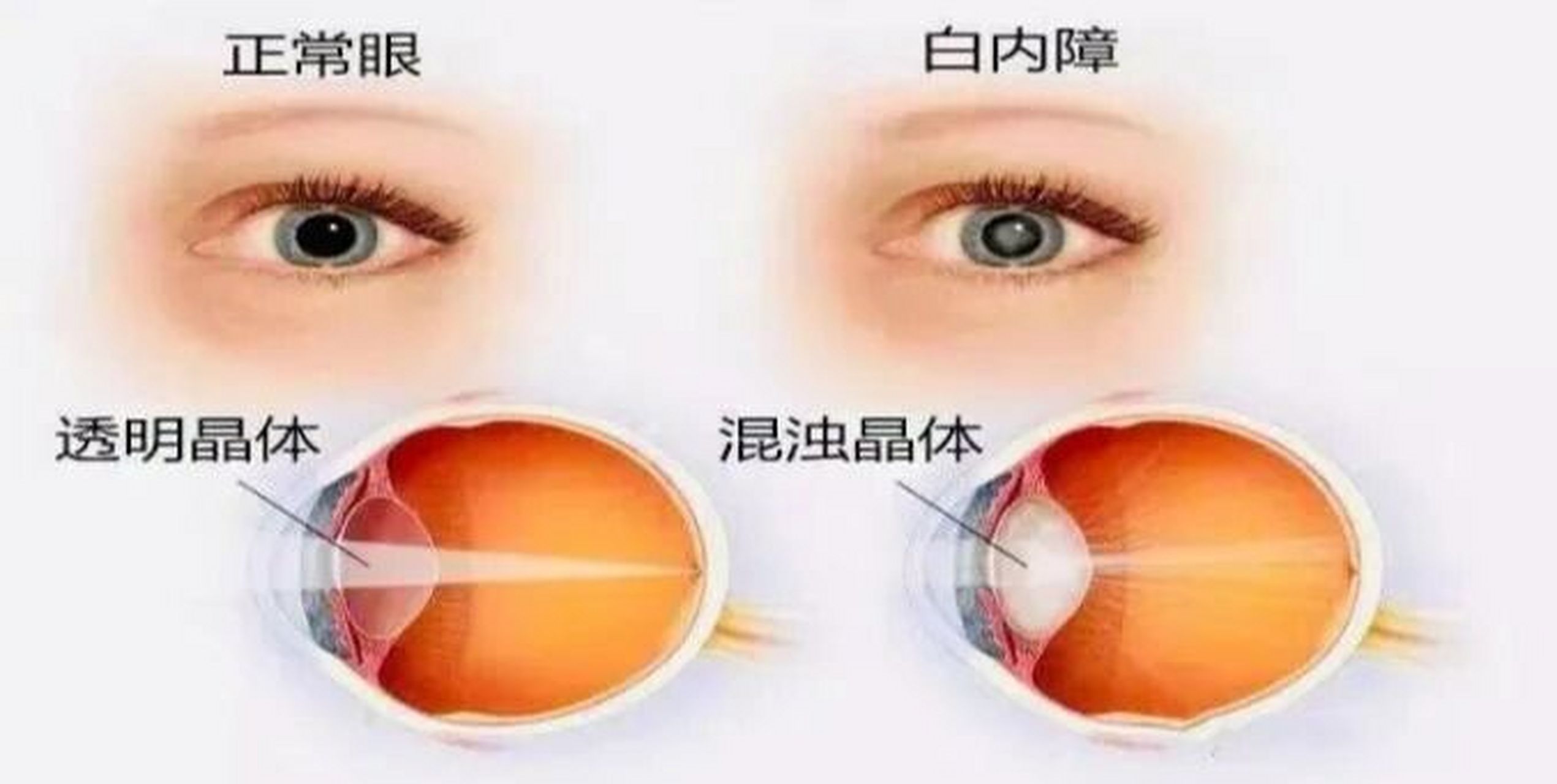 白内障还有哪些症状?