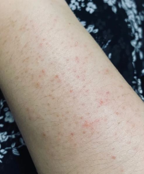 小腿长红疙瘩最常见的原因是毛囊炎,过敏性湿疹或蚊虫叮咬