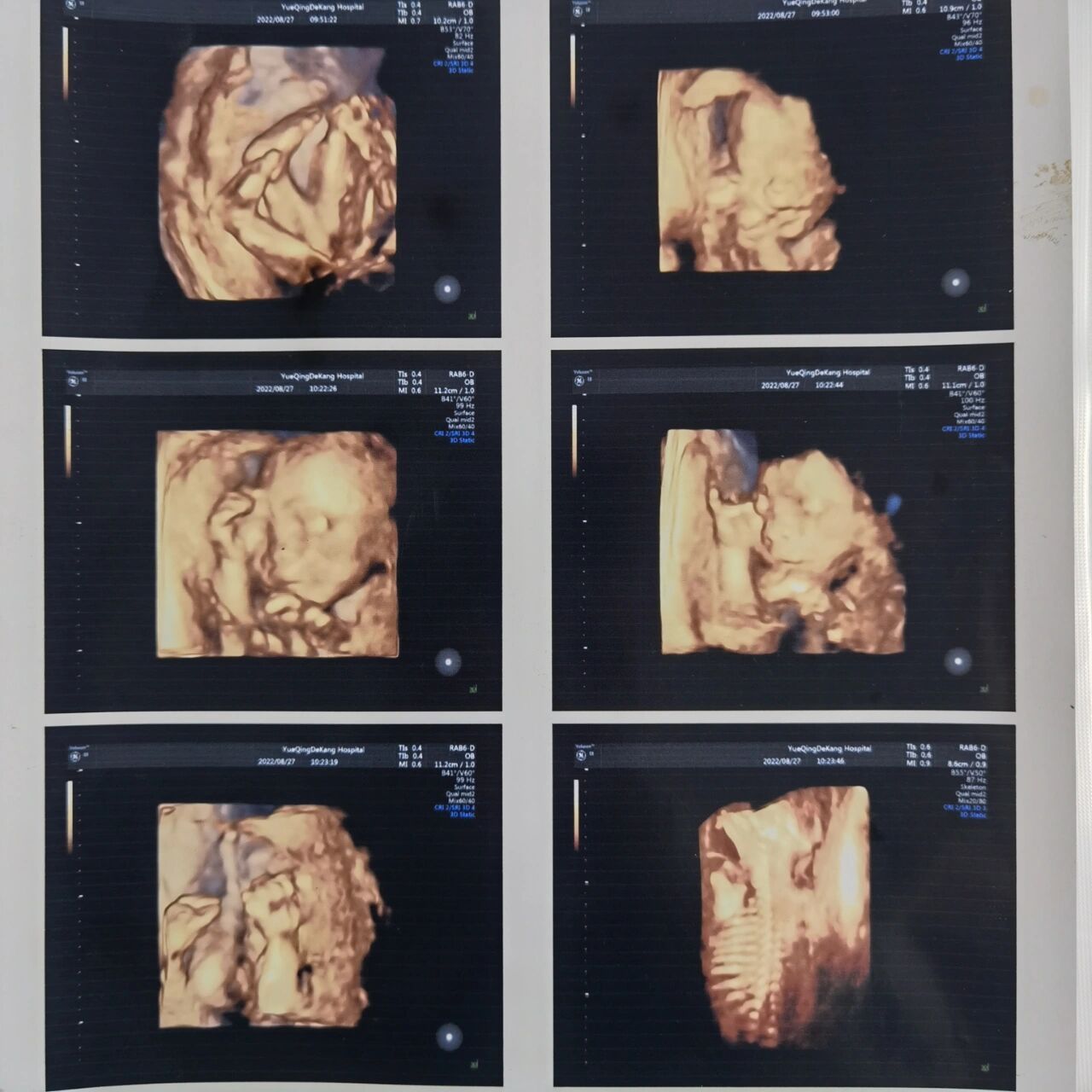 久违的四维彩超图片以及马上孕6个月的肚子~ 22 5做四维的日子 一直