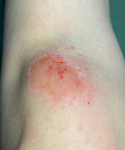 伤口出水,渗液是常见的创伤表现,通常由表皮,皮