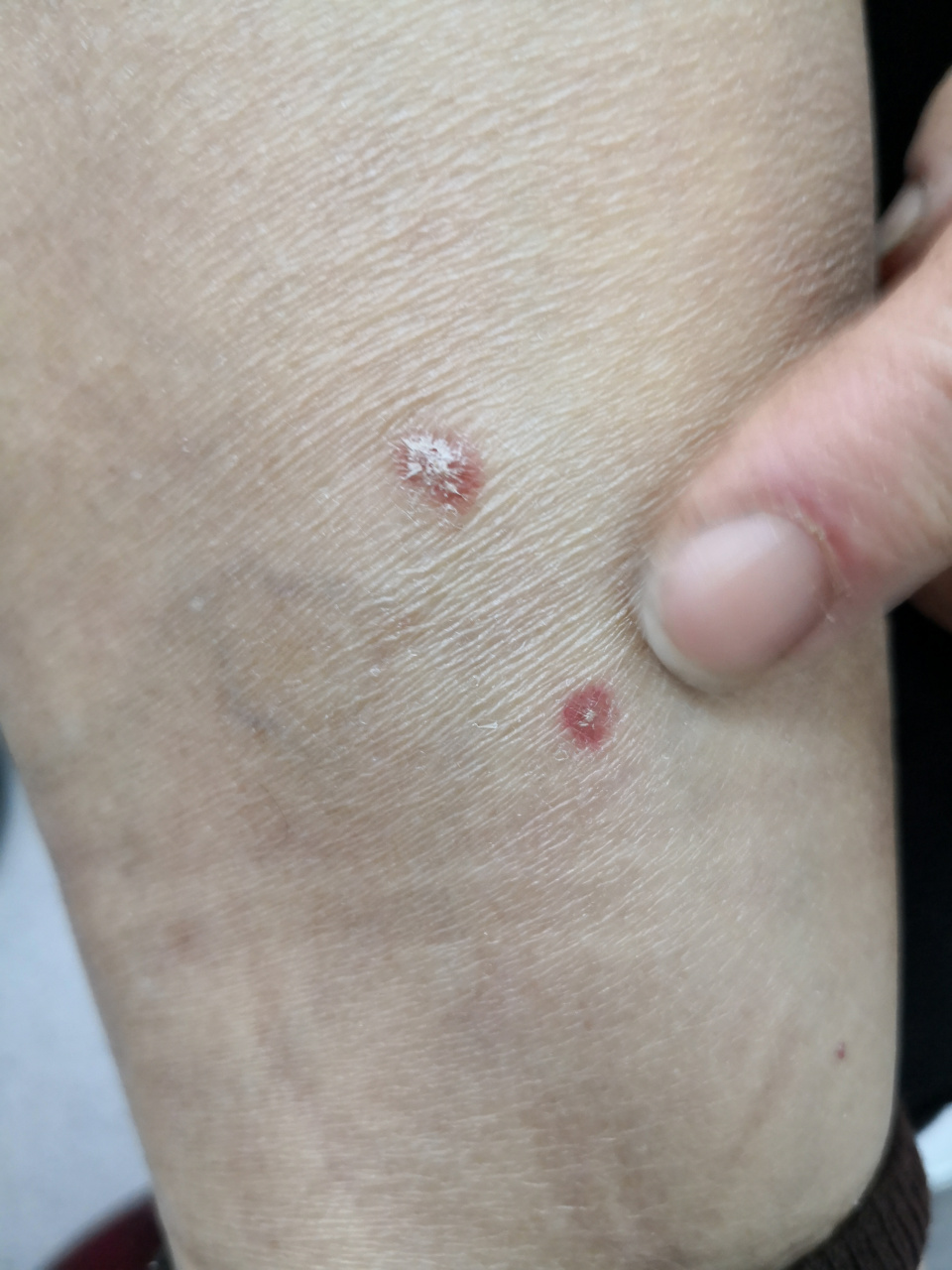 面部,躯干,四肢的鳞屑性斑块症状.考虑银屑病症状.#牛皮癣##银屑病