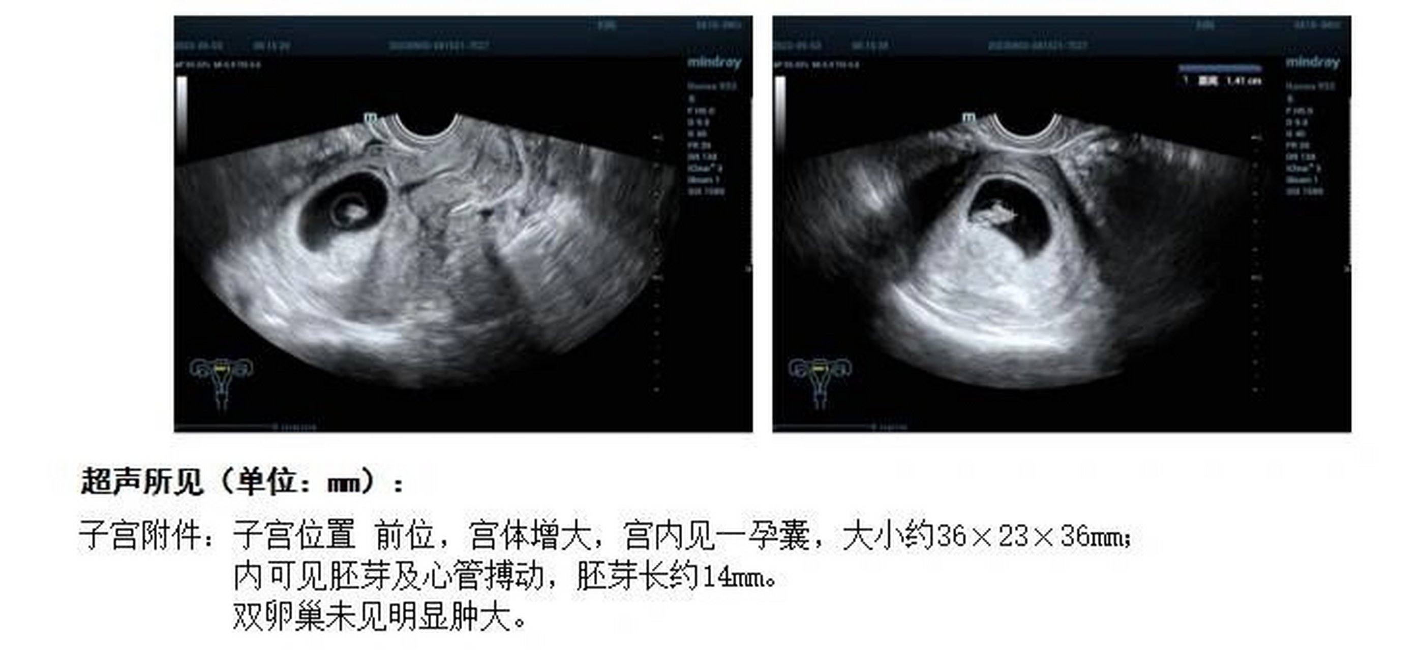 怀孕七周男孩孕囊图片图片