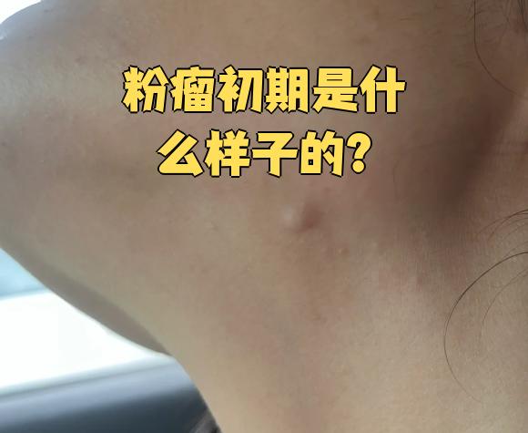 粉瘤初期通常表现为皮肤上的小疙瘩,摸起来像结节块,一般不会疼也不