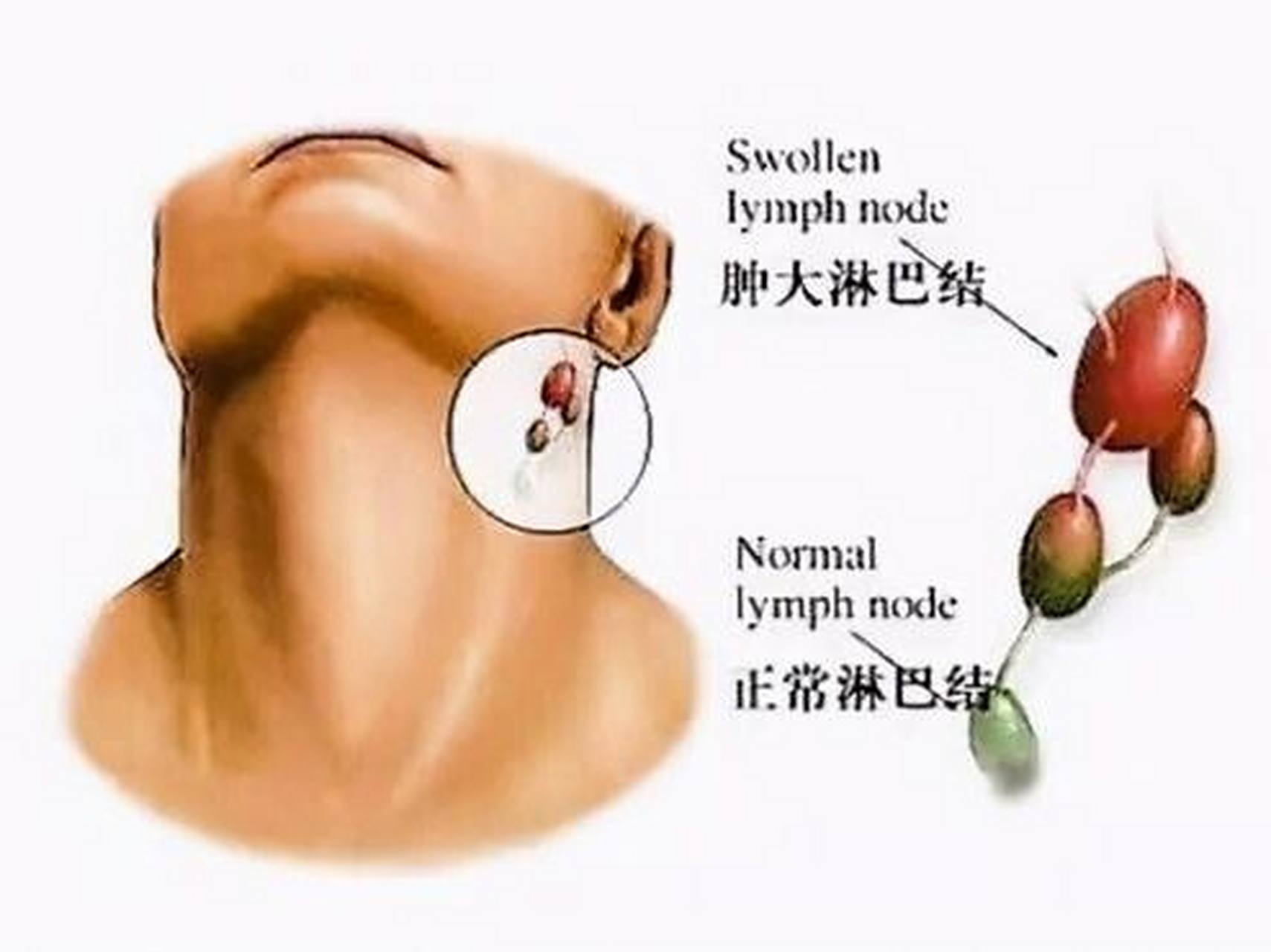 甲状腺癌早期的五大症状!