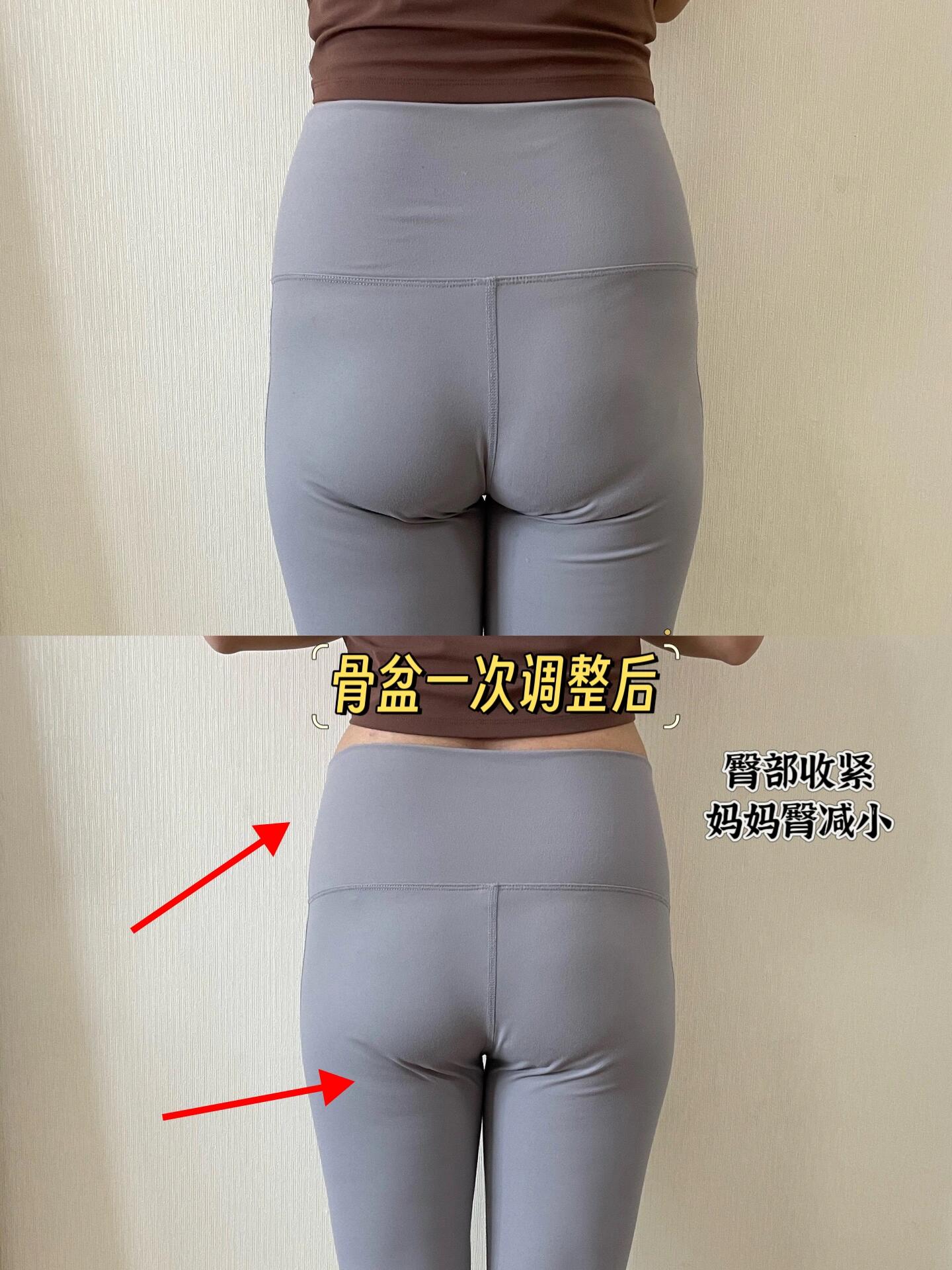 骨盆修复前后一次对比 骨盆修复一次前后效果对比90 闭合骨盆,恢复