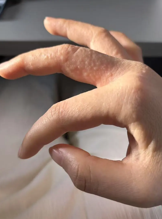 手指缝出现密密麻麻的小水泡,可能是汗疱疹,湿疹或手癣引起的,需要