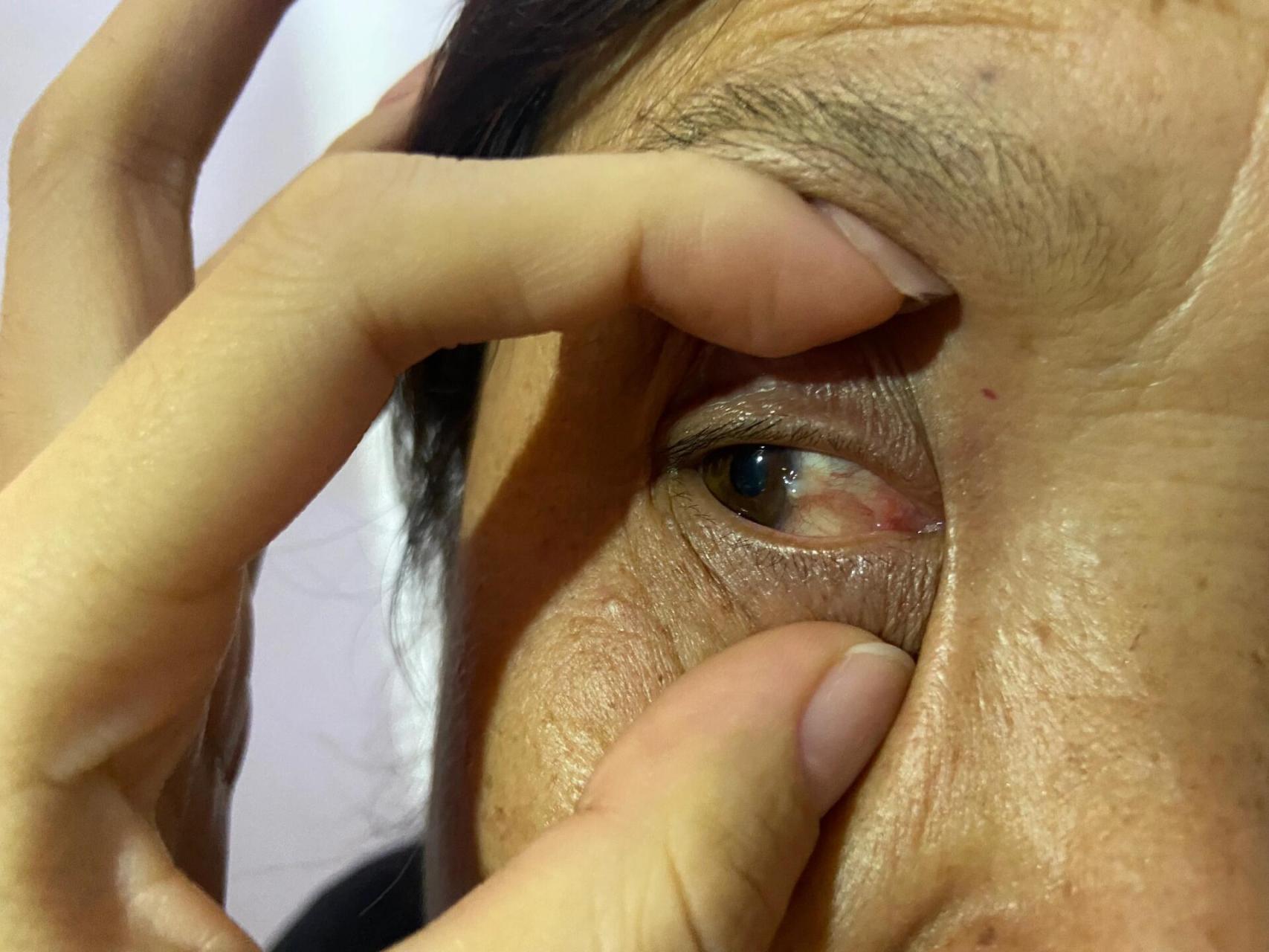 眼翳 病人右眼内眦到瞳孔处 眼翳 病人右眼内眦到瞳孔处