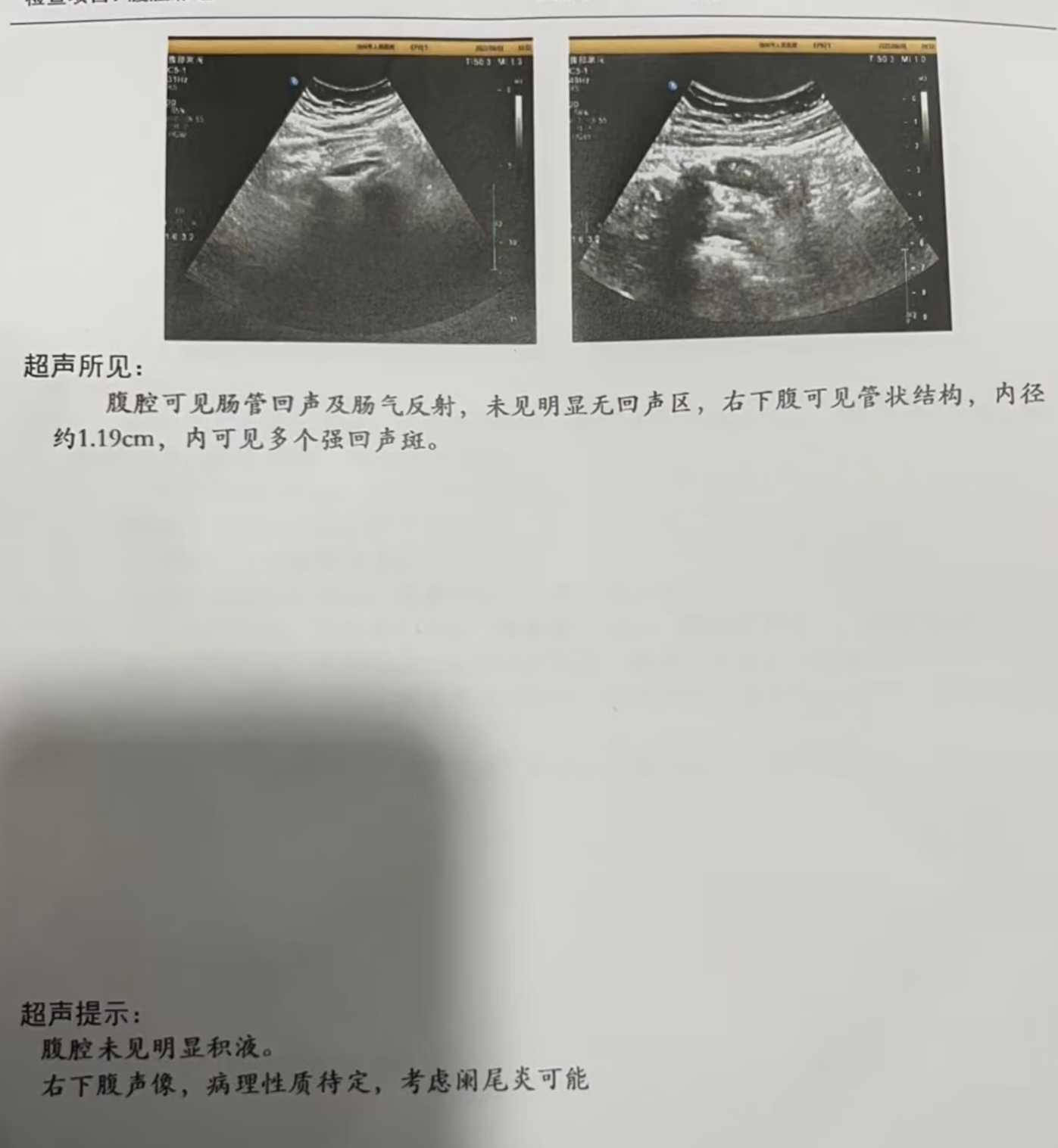 做阑尾彩超通常不需要空腹
