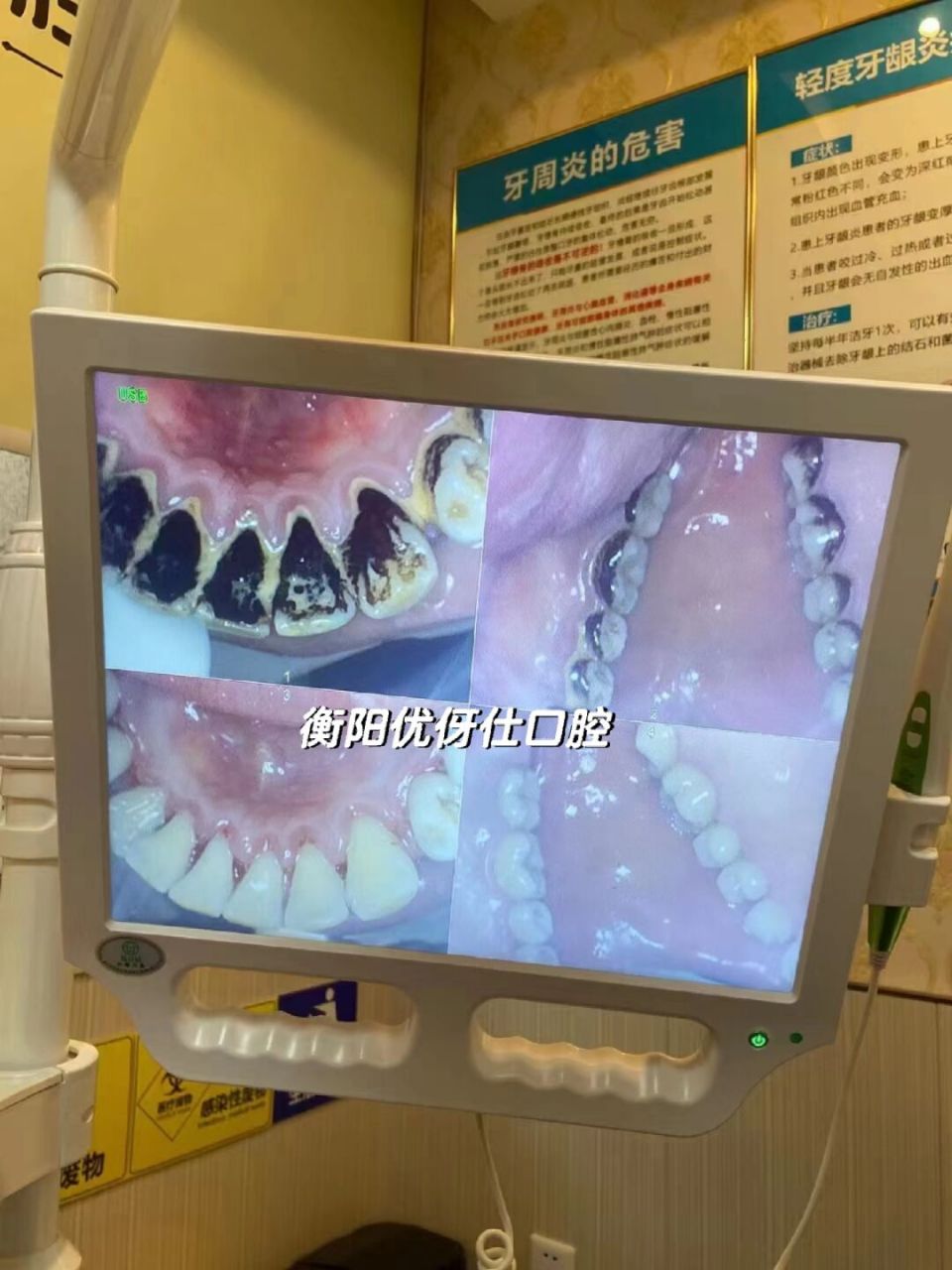 洗牙前后对比,洗完观感不要太舒适!