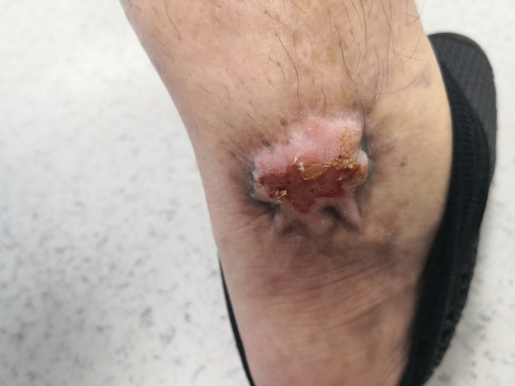 跟腱上方的斑块状硬结,瘢痕疙瘩症状.可以活检诊断一下确定诊断.#解决