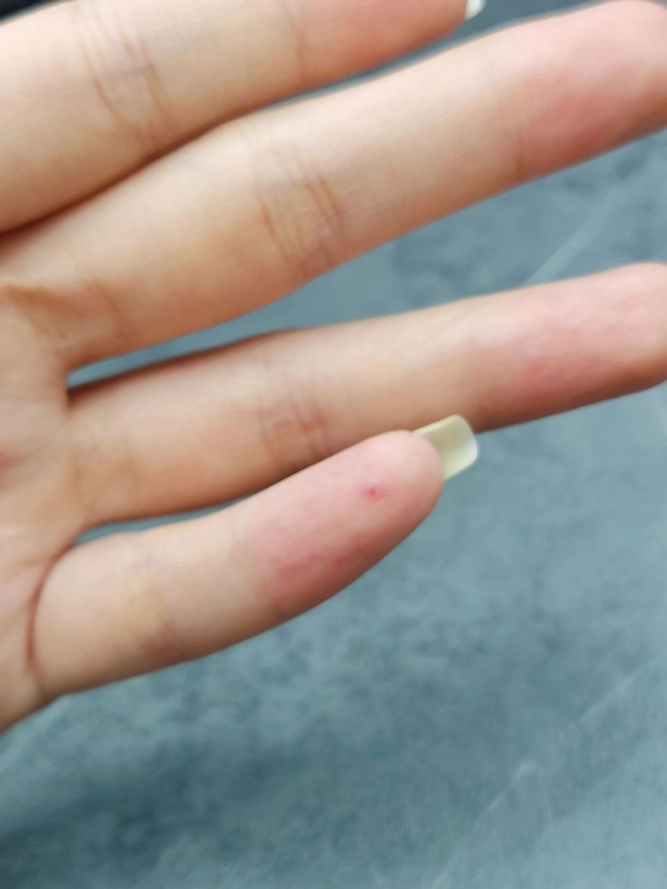 大概是高中上课无聊玩手指发现手背有个不痛不痒的小红点,到现在一