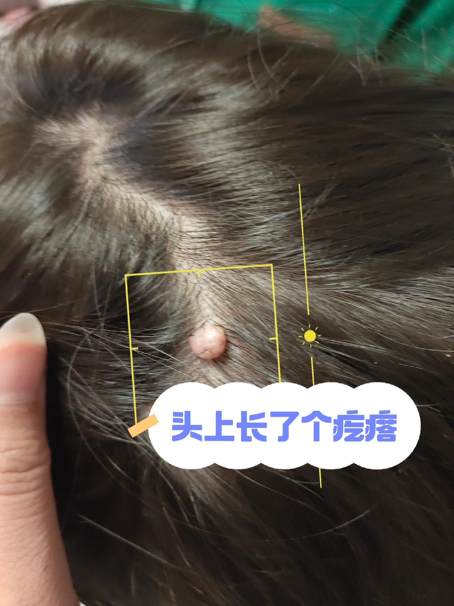 头上长了个肉疙瘩