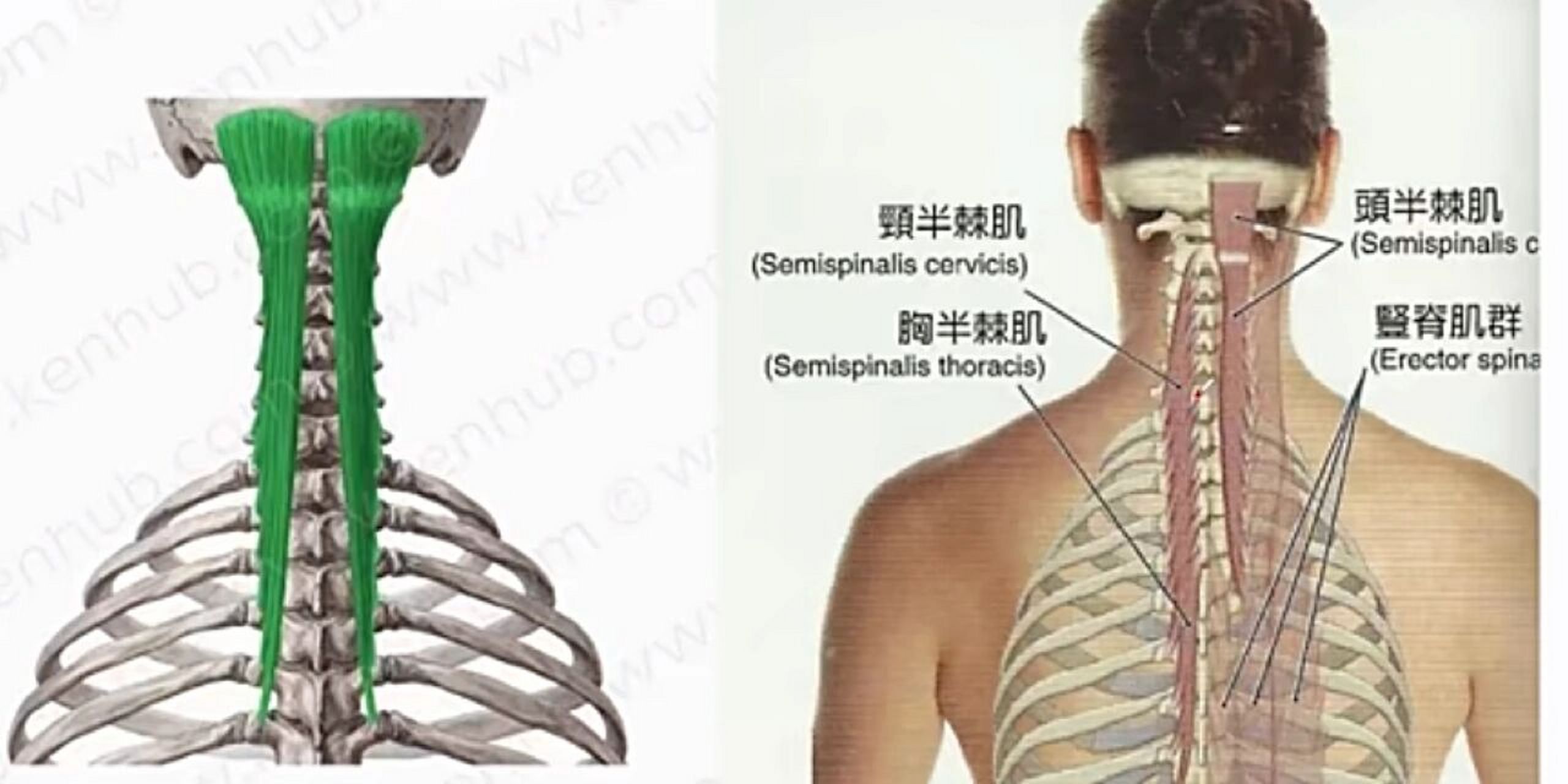 运动解剖【半棘肌 头前引,头痛相关肌肉】 1.