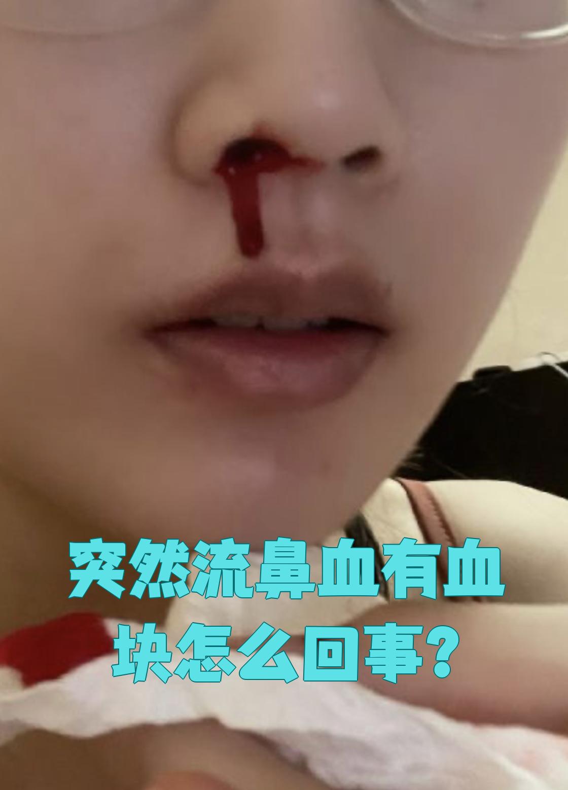 突然流鼻血还带血块,常见原因有环境干燥,鼻部外
