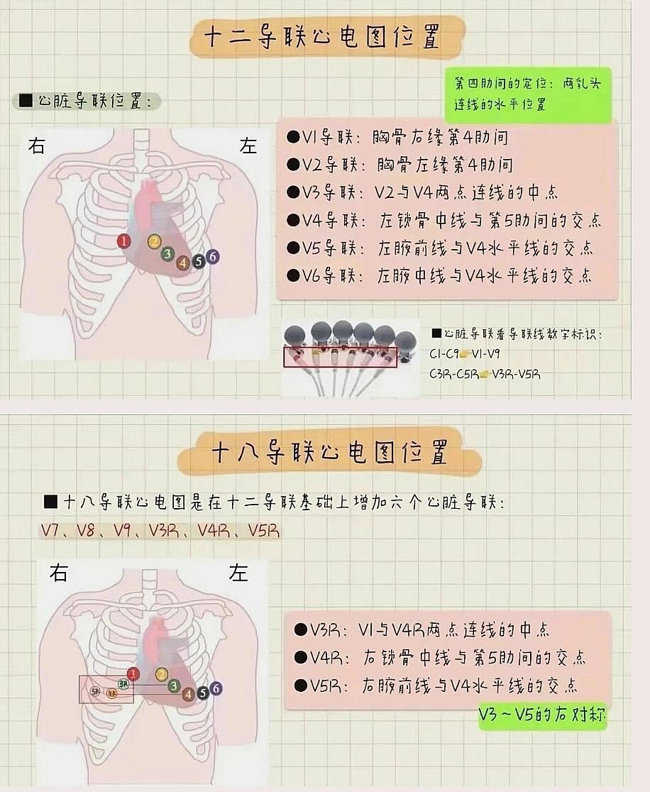 胸导联v1到v6的位置图片