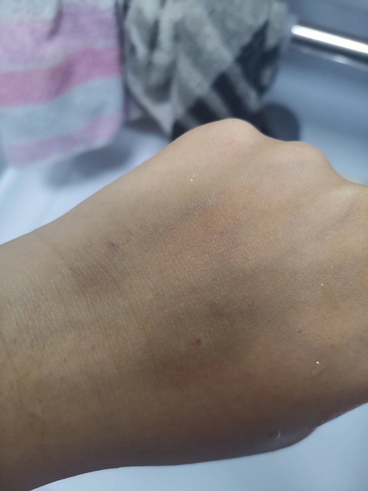 挂水挂的手都青了呜呜呜 前几天感冒了  去医院