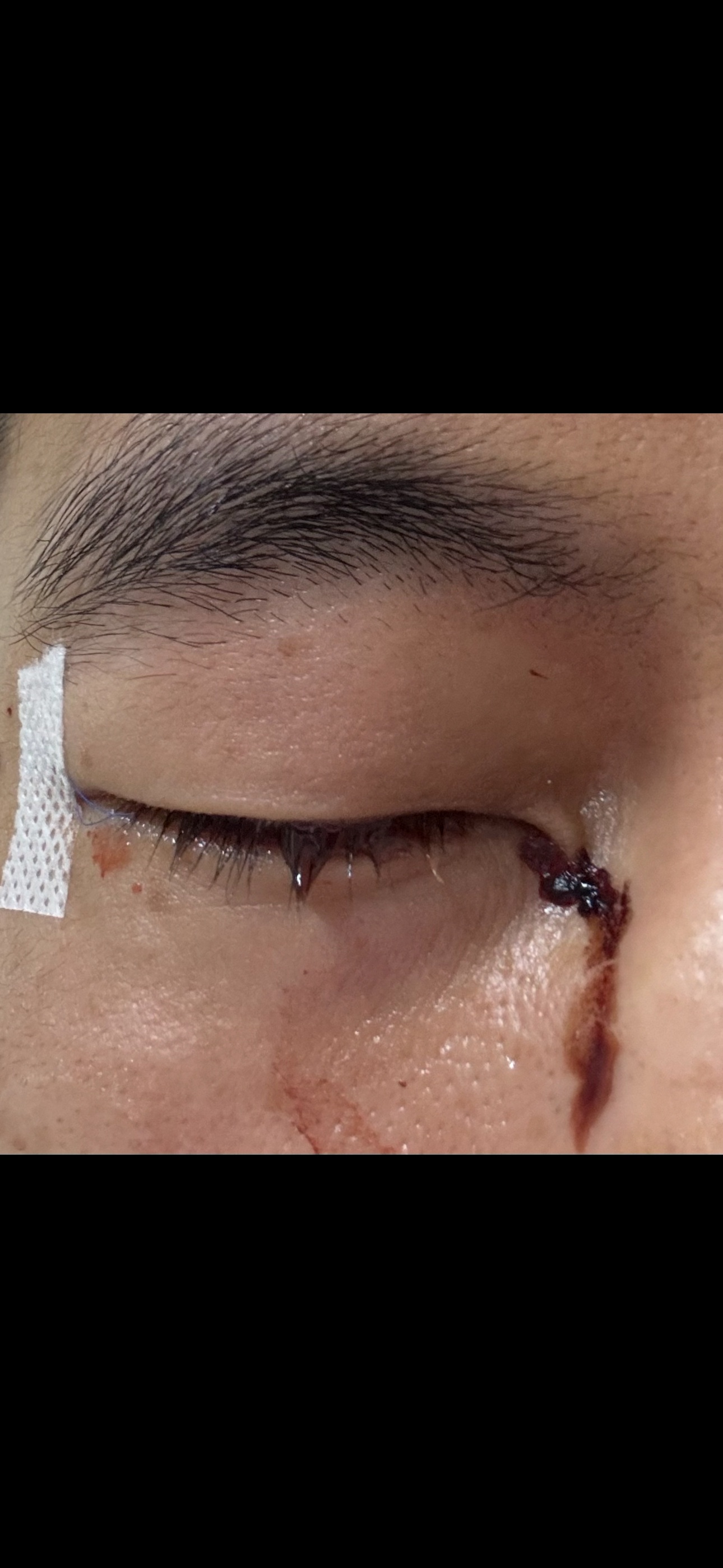 郭艾伦面部受伤# 郭艾伦近日在训练中意外伤到面部,伤情严重已经住院