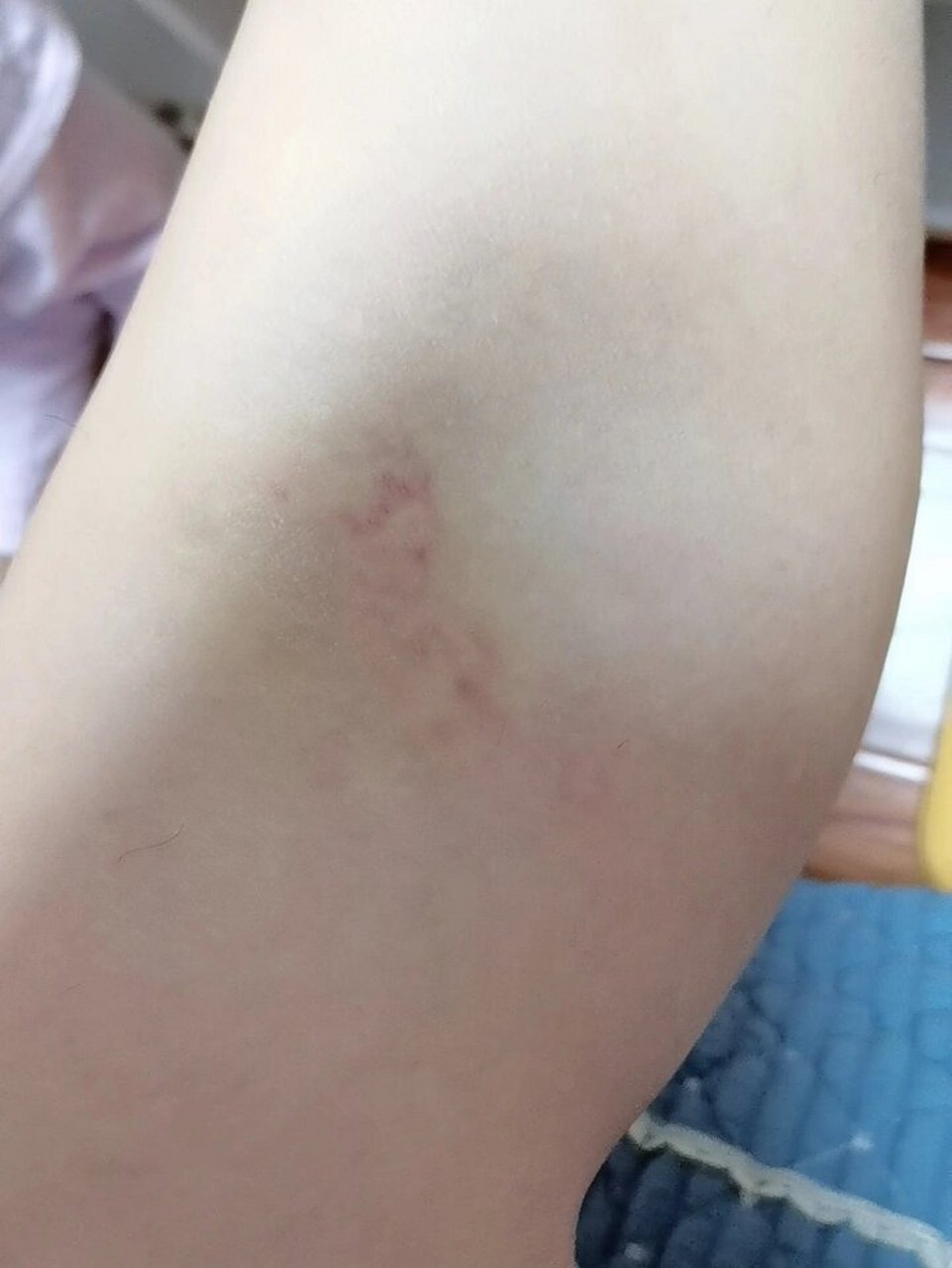 毛细血管破裂 腿部毛细血管破裂怎么办?