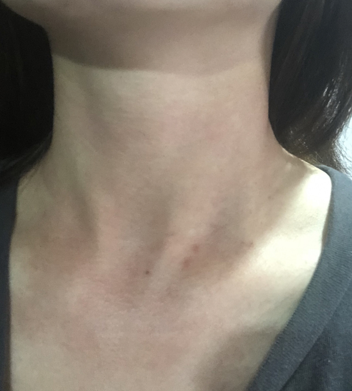 脖子过敏怎么办 脖子一直反复过敏,也没吃什么易过敏的食物,愁死人,有