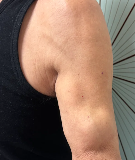 胳膊上臂肌肉鼓包不疼不痒按压有疼痛是怎么回事怎么办?