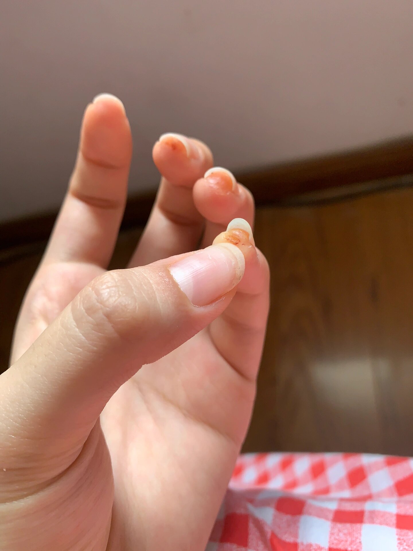 游离线已经跑到中间了,对比右手小拇指,而且几乎全部手指都起了小水泡