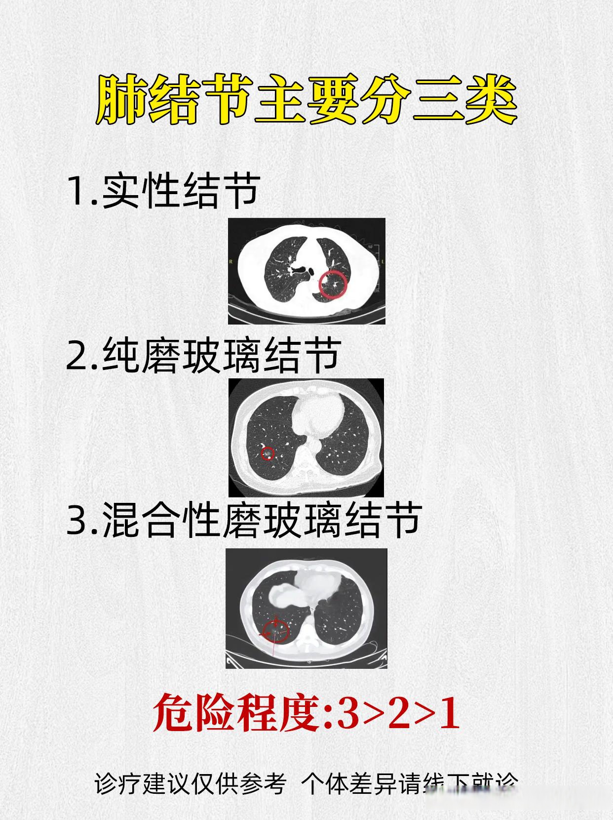 肺结节主要分三类,这些危险程度,要谨记! 肺结节结节呼吸肺病