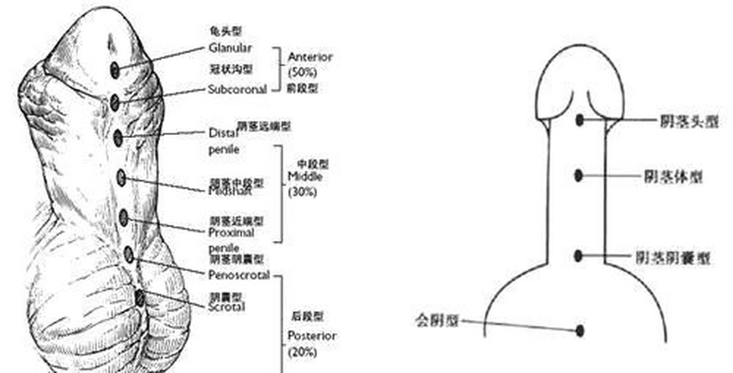 尿道下裂分型的图片图片