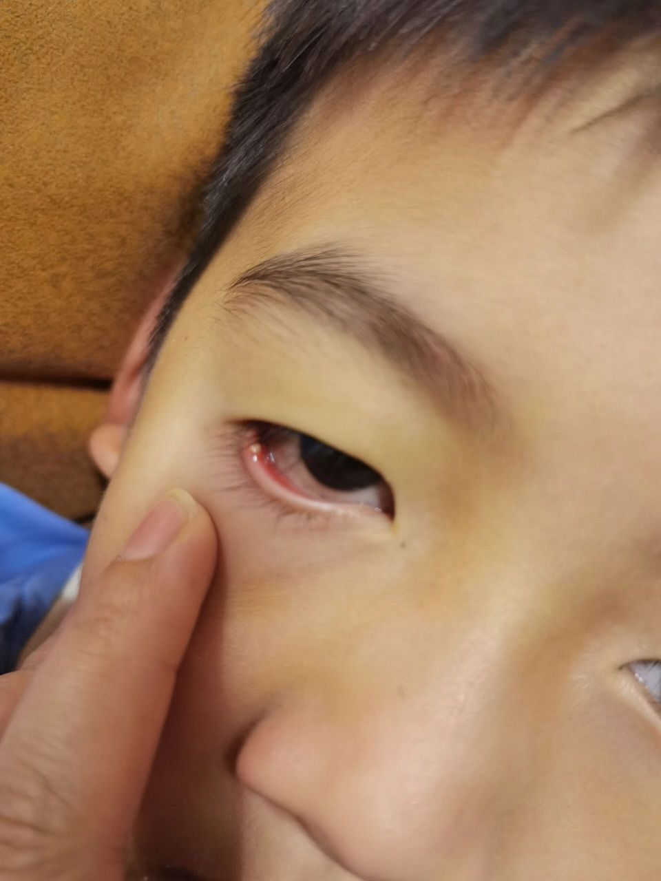 小朋友发完烧后,下眼睑突然这样了?怎么回事