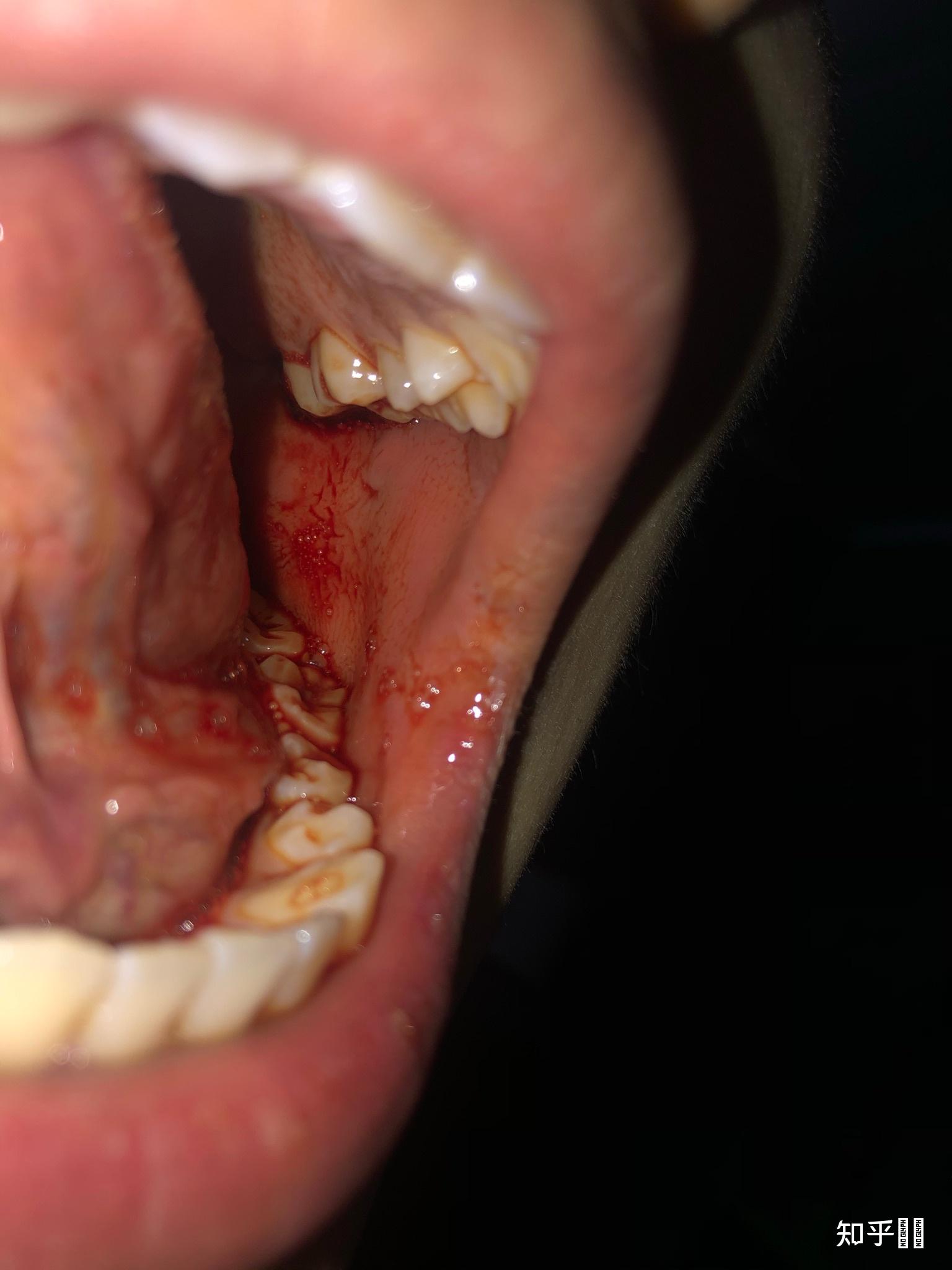 拔了智齿后一直有血块正常吗