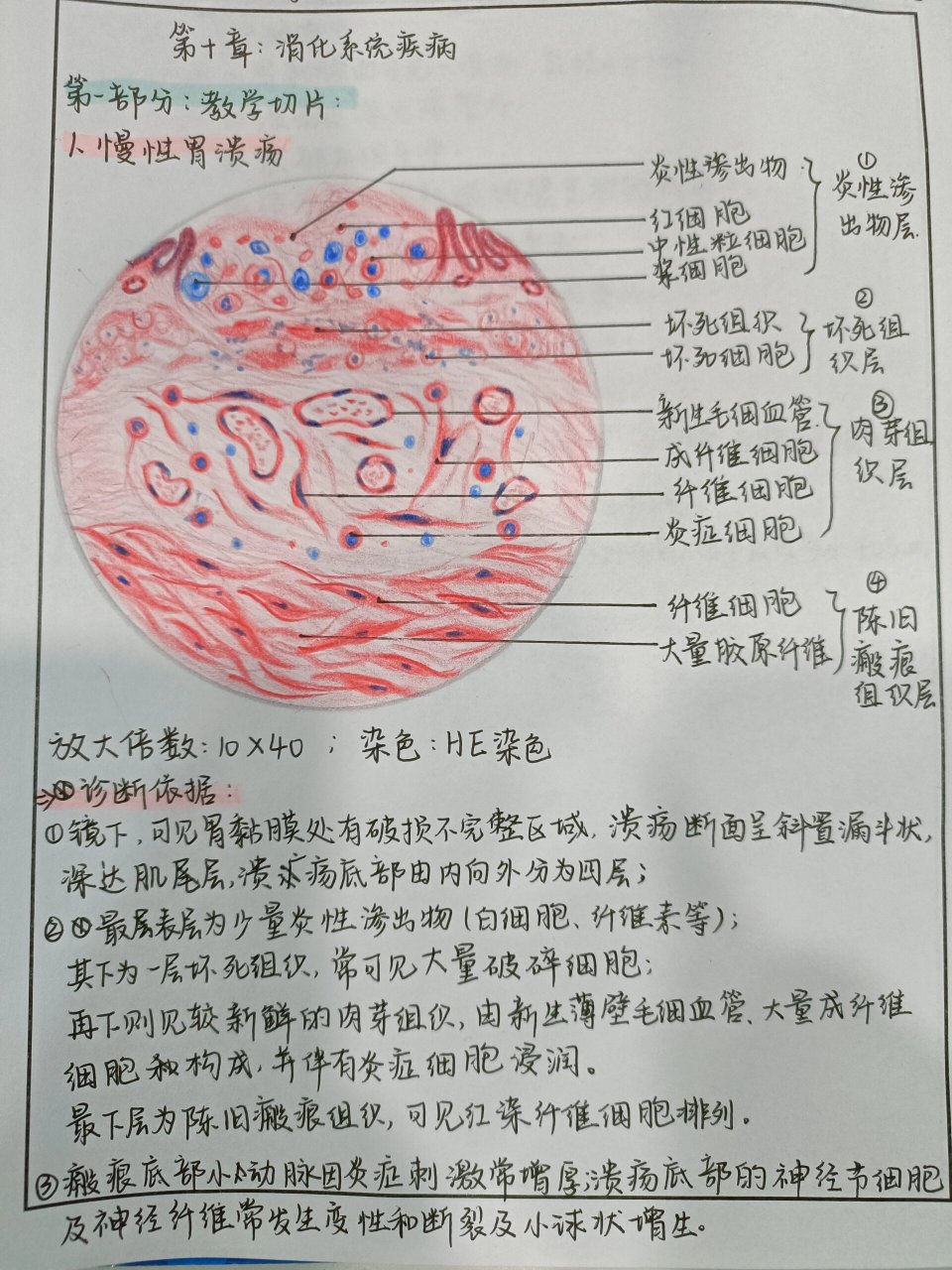 手绘病理实验报告-消化系统 切片红蓝铅笔绘图:慢性胃溃疡和肝癌; 大