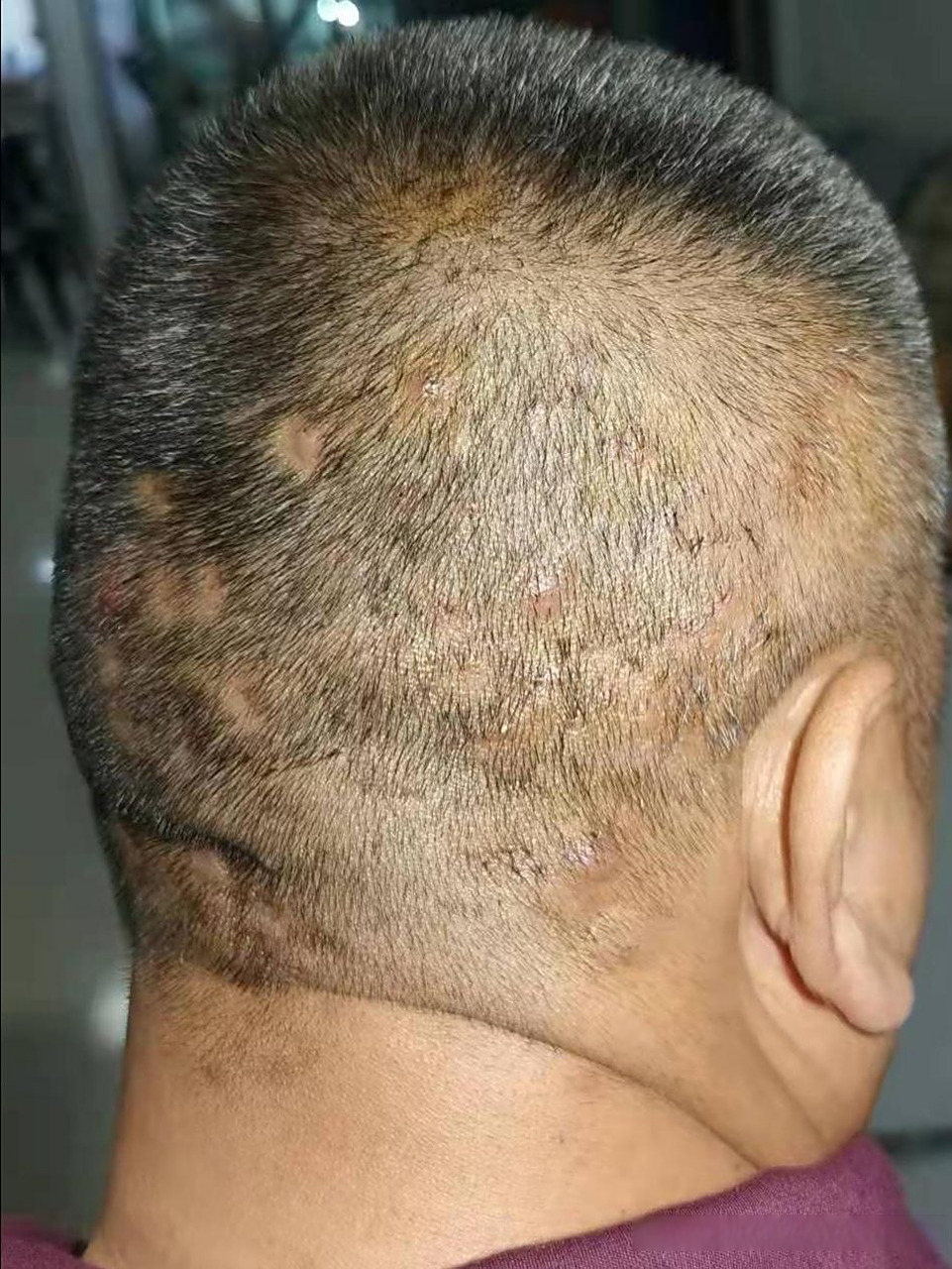 红肿痒痛,男子后脑勺疙瘩不断,中医帮他"一举拿下"!