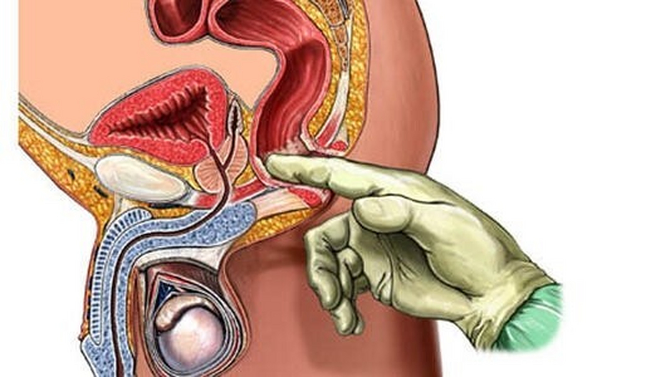 前列腺按摩法 按摩疗法 前列腺按摩疗法就是通过定期对前列腺按摩