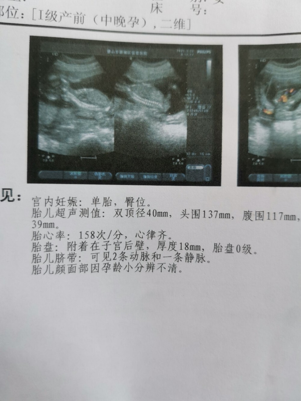 17周b超,能否看出男宝还是女宝,第一胎真的好好奇,网上个种搜