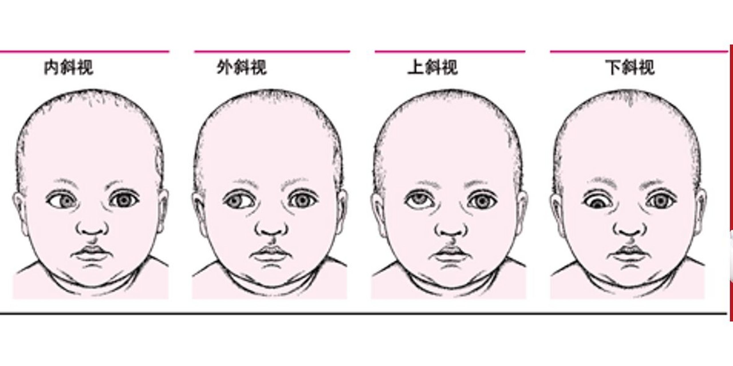 斜视可以根据不同的分类方式进行分类和描述