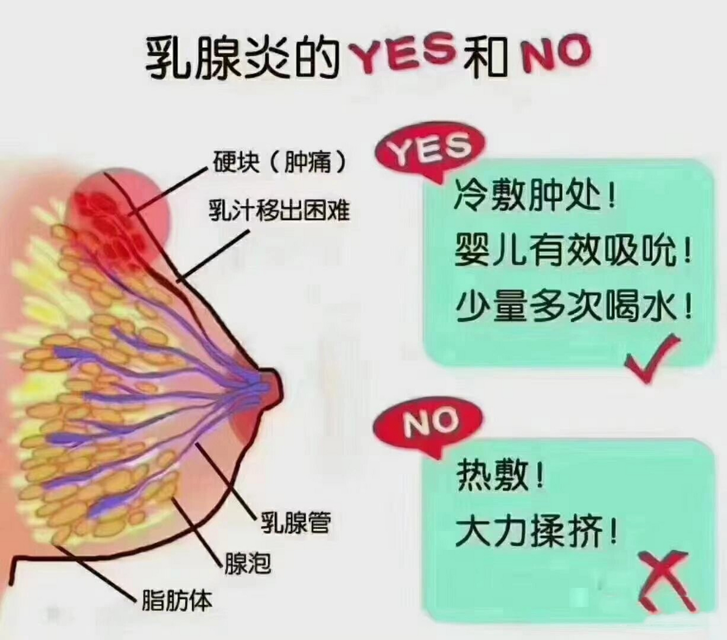 乳房结构图中乳房硬块图片