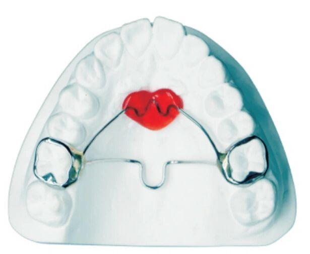 正畸辅助装置-横腭杆与nance托 166横腭杆也叫tpa:不锈钢丝弯制,与