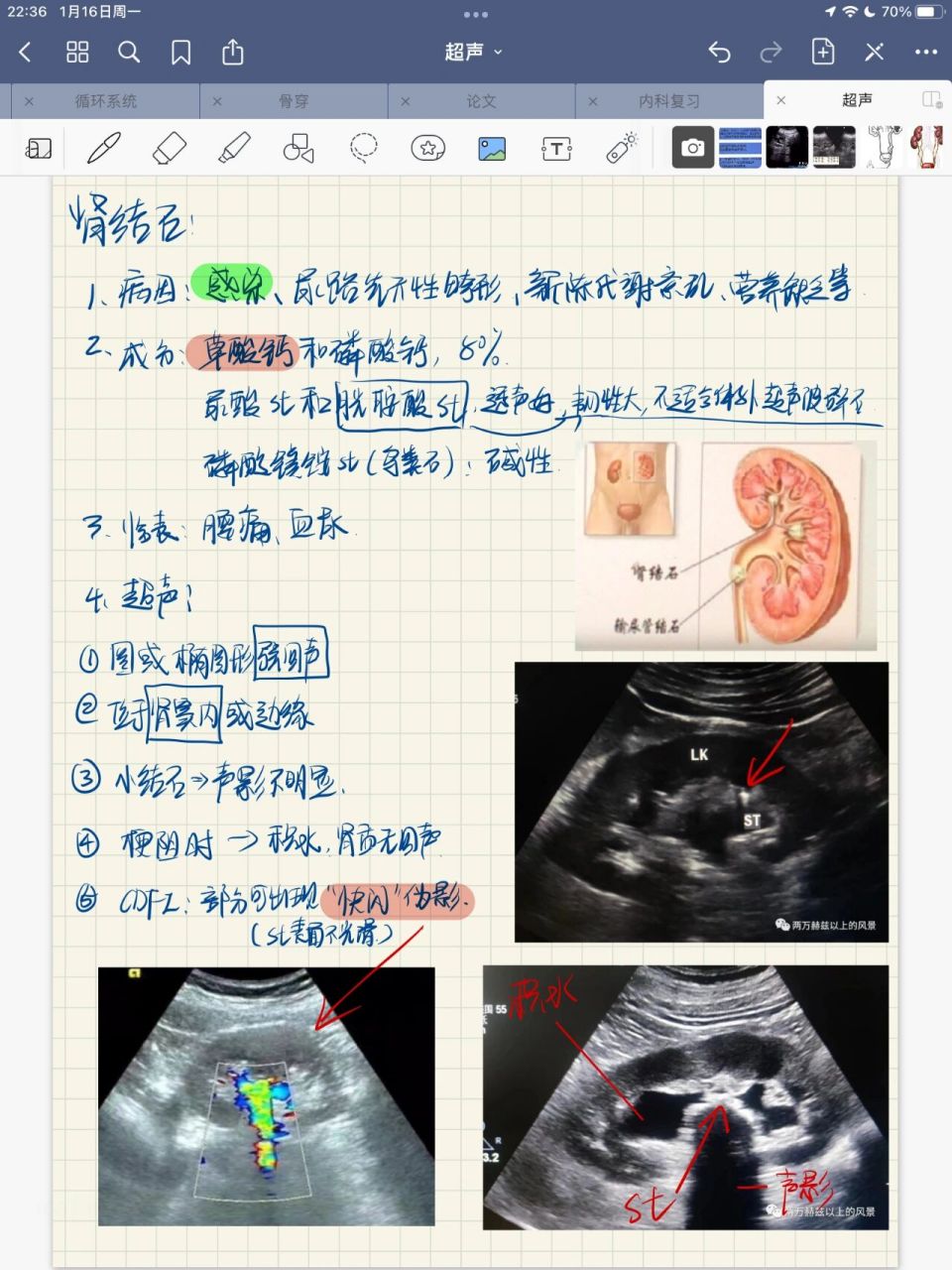 肾结石彩超图片说明图片