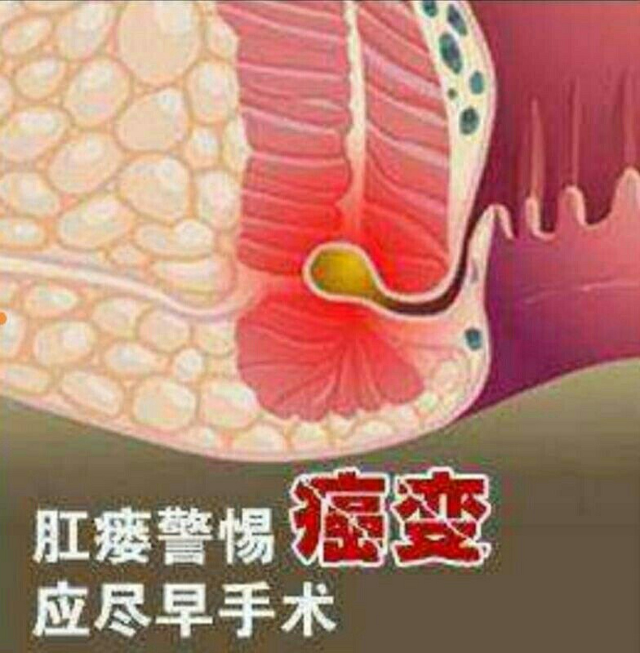 肛门周围有肉疙瘩,痒痒的,一定要小心肛痿 肛痿是肛门直肠痿的简称,是