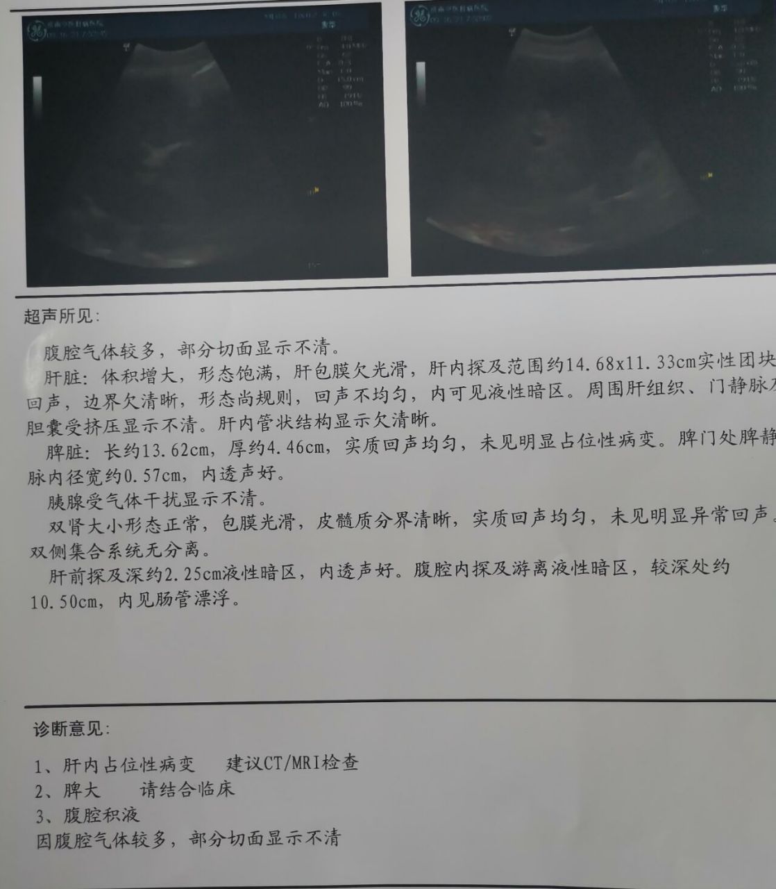 1,肝血管瘤 不仅是肝脏,其实身体的每一个部分,甚至包括皮肤都可能会