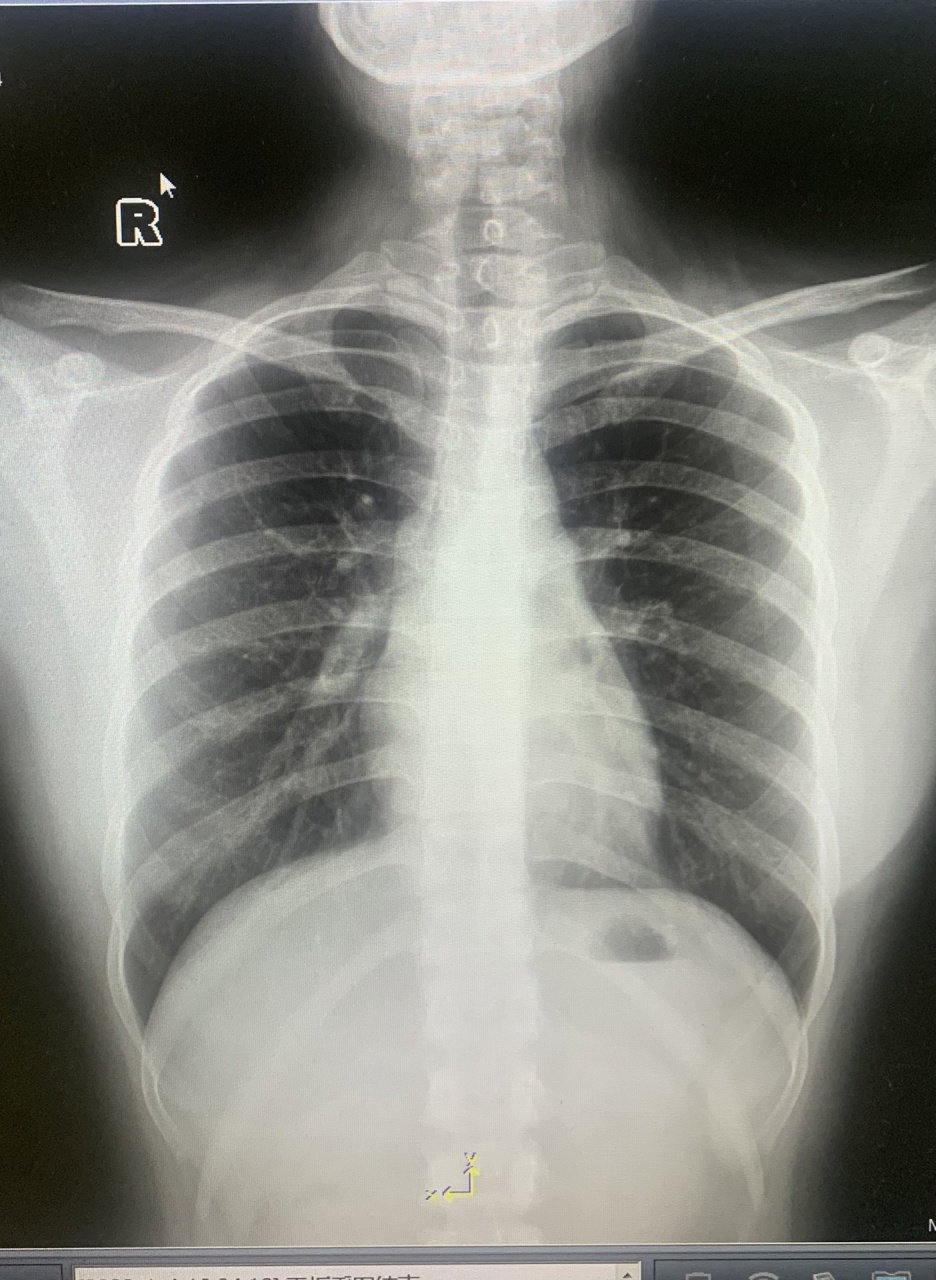 查肺有没有感染,医生给拍了个胸片95 也不知道这肺有没有感染