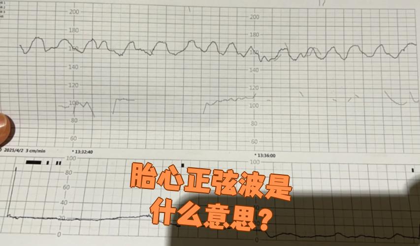 胎心正弦波指的是胎心监护图上出现的特殊波形,看起来像规则的波浪